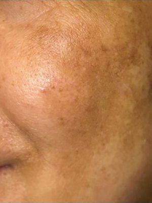 A close up of a woman 's face with spots on it.