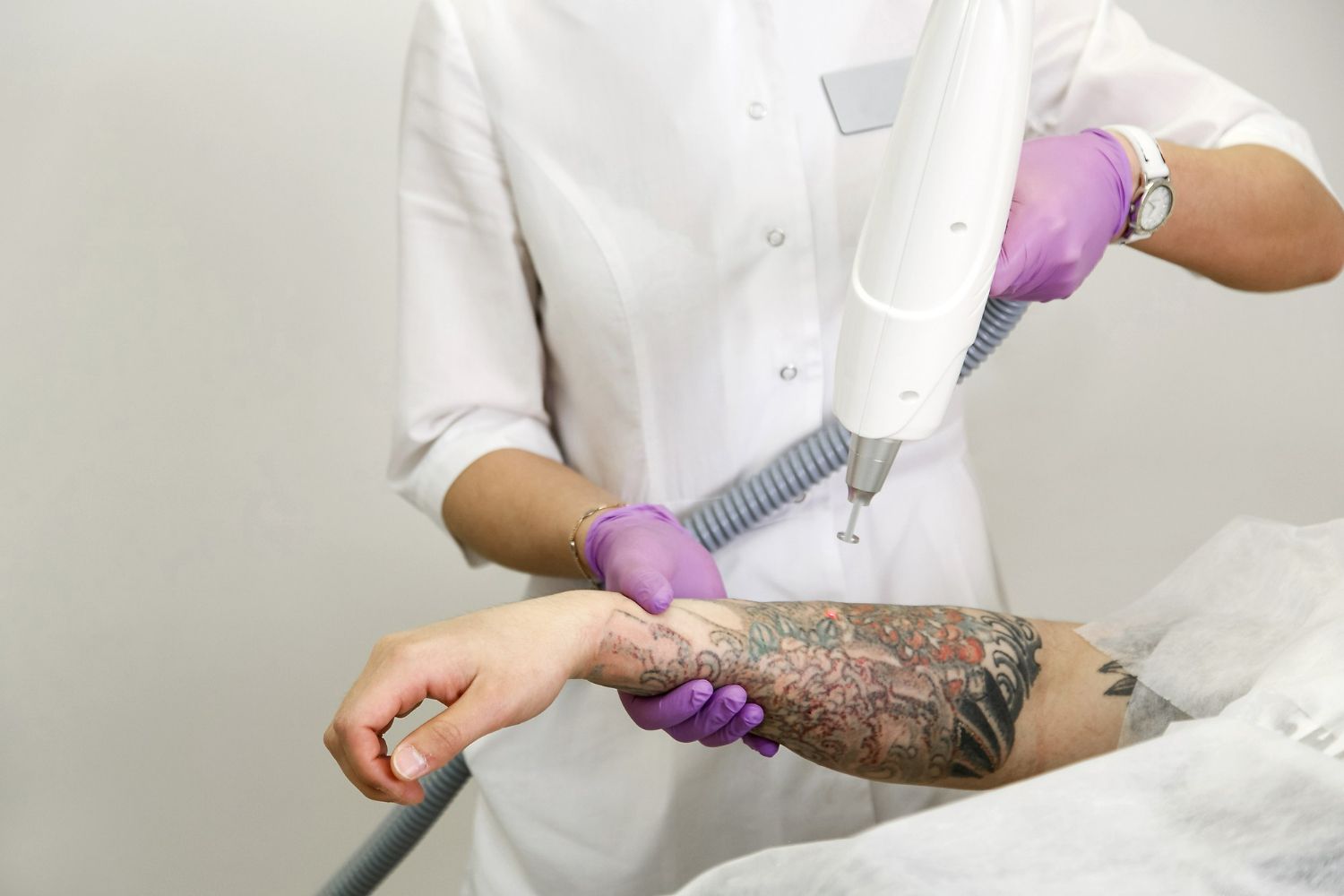 Person in lab coat using laser on arm tattoo. Purple gloves, medical setting.