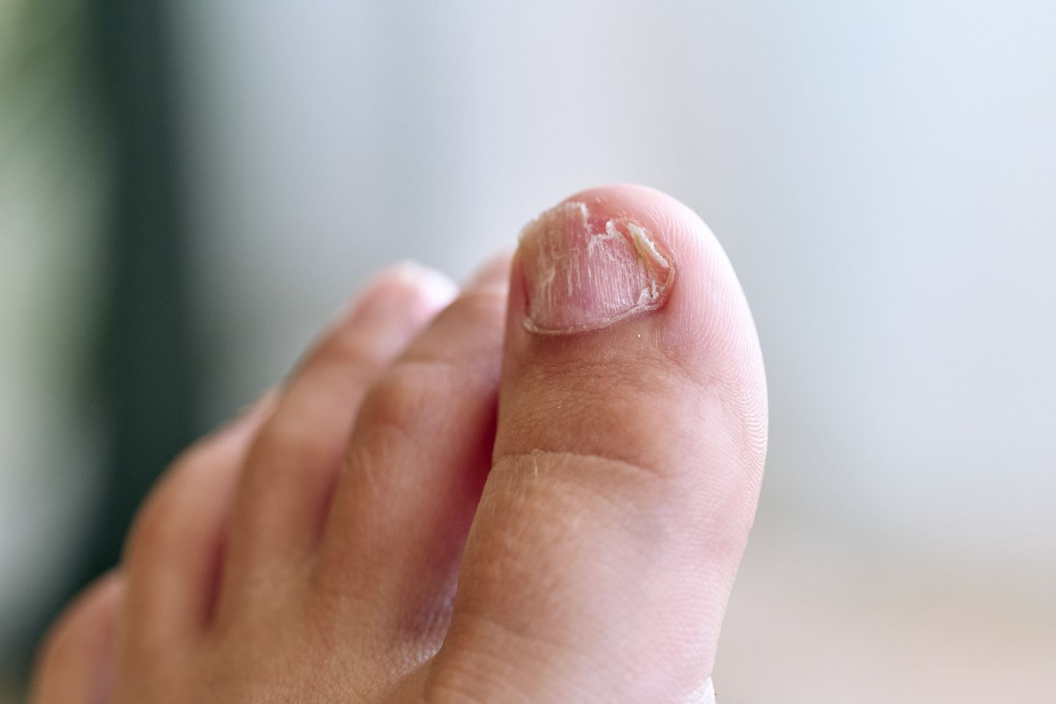 Close-up of a toe with a damaged toenail. The nail appears dry, cracked, and discolored.