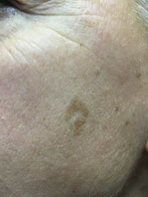 A close up of a woman 's face with a few brown spots on it.