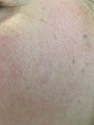 A close up of a woman 's face with red spots on it.