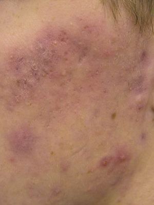 A close up of a person 's face with acne on it.
