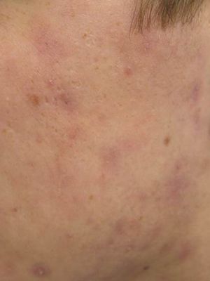 A close up of a person 's face with acne on it.