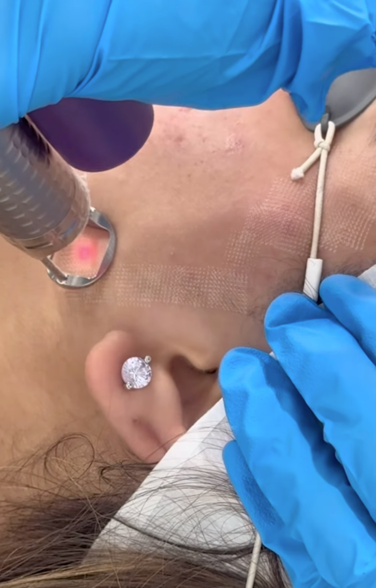 A woman is getting a laser treatment on her face.