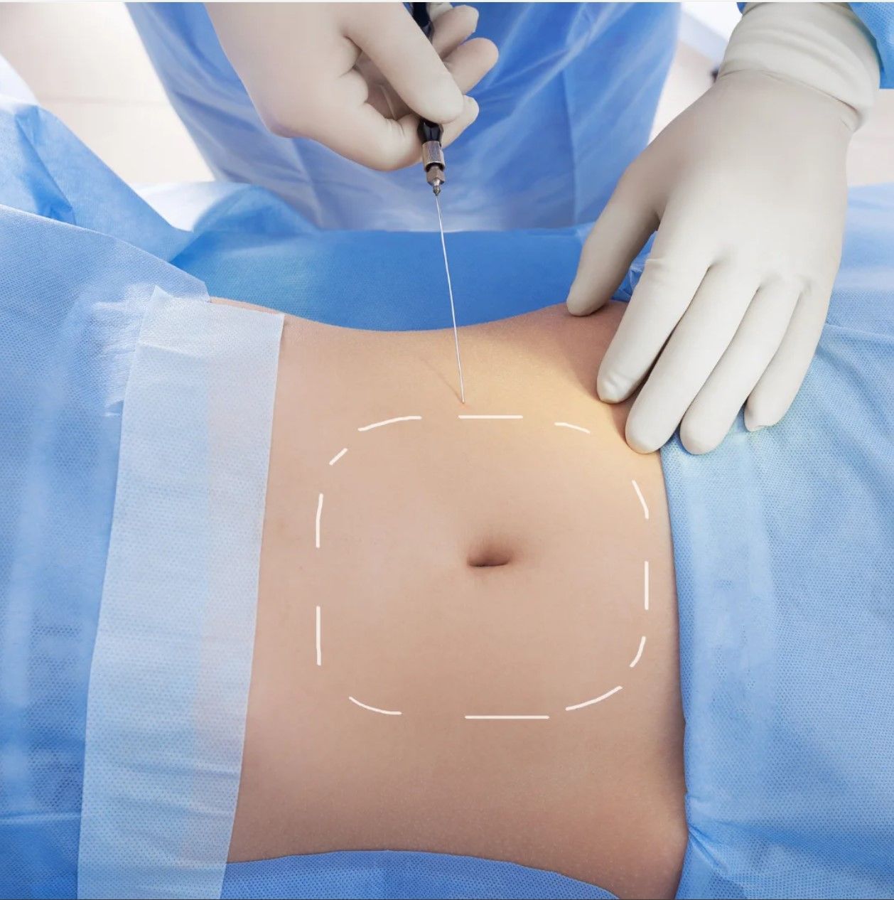 A surgeon is drawing a line on a woman 's stomach