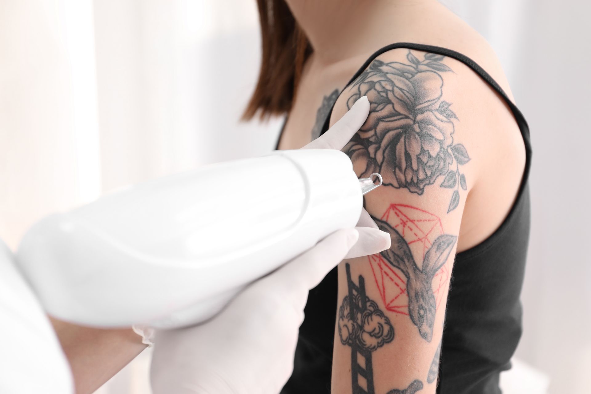 A woman is getting a tattoo removed from her arm.