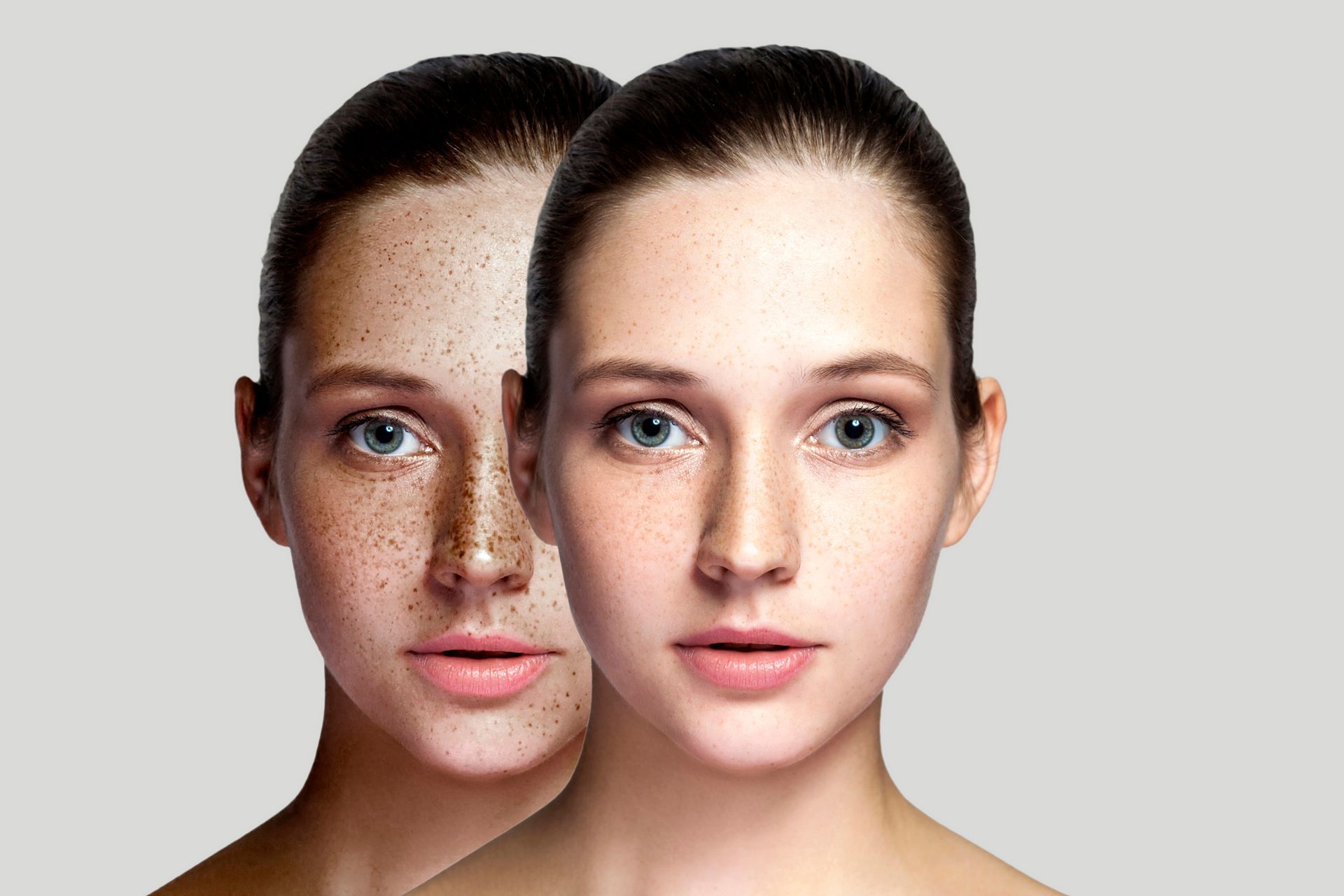 A before and after photo of a woman 's face with and without freckles.