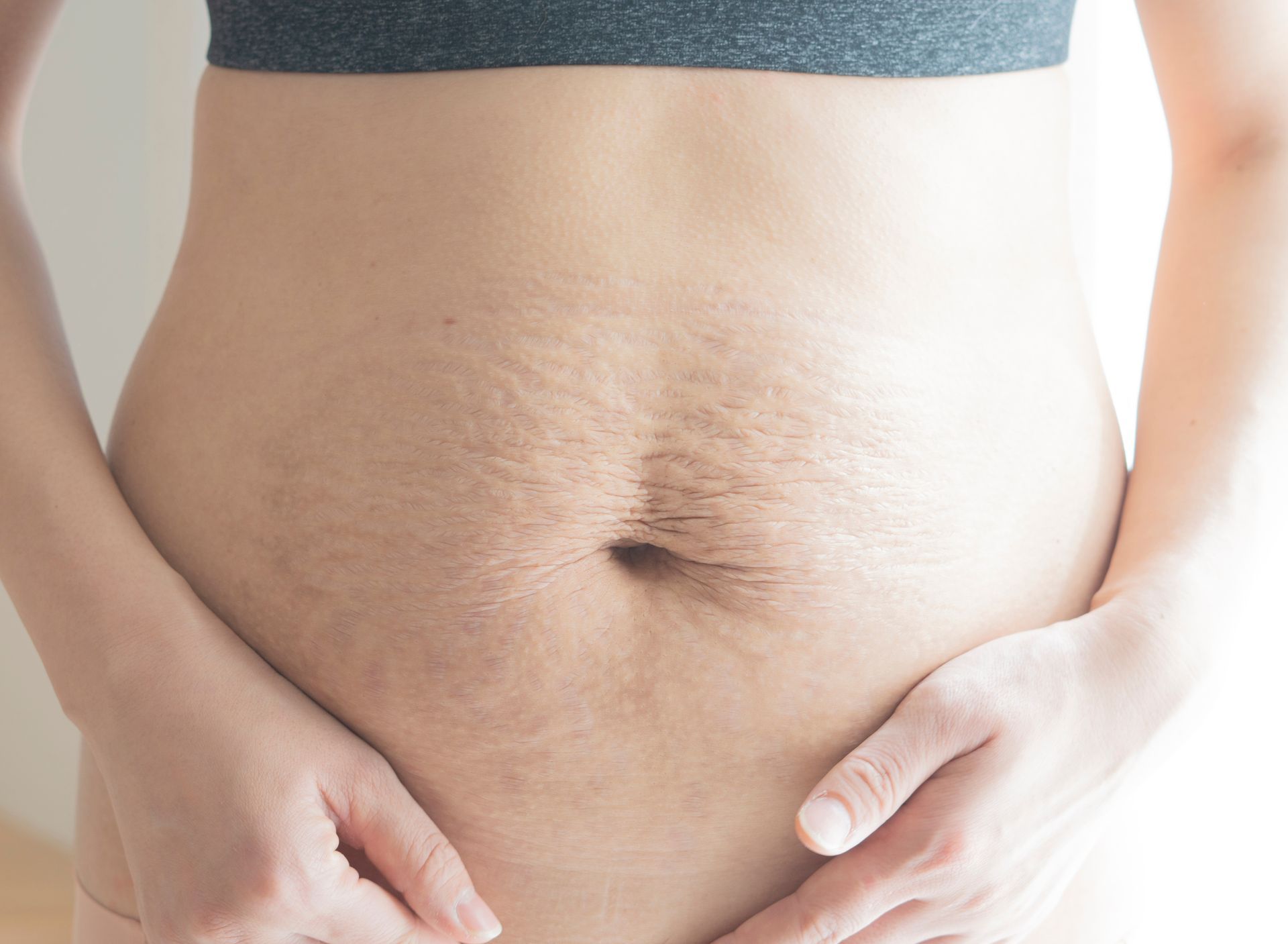 A woman is holding her stomach with stretch marks on it.