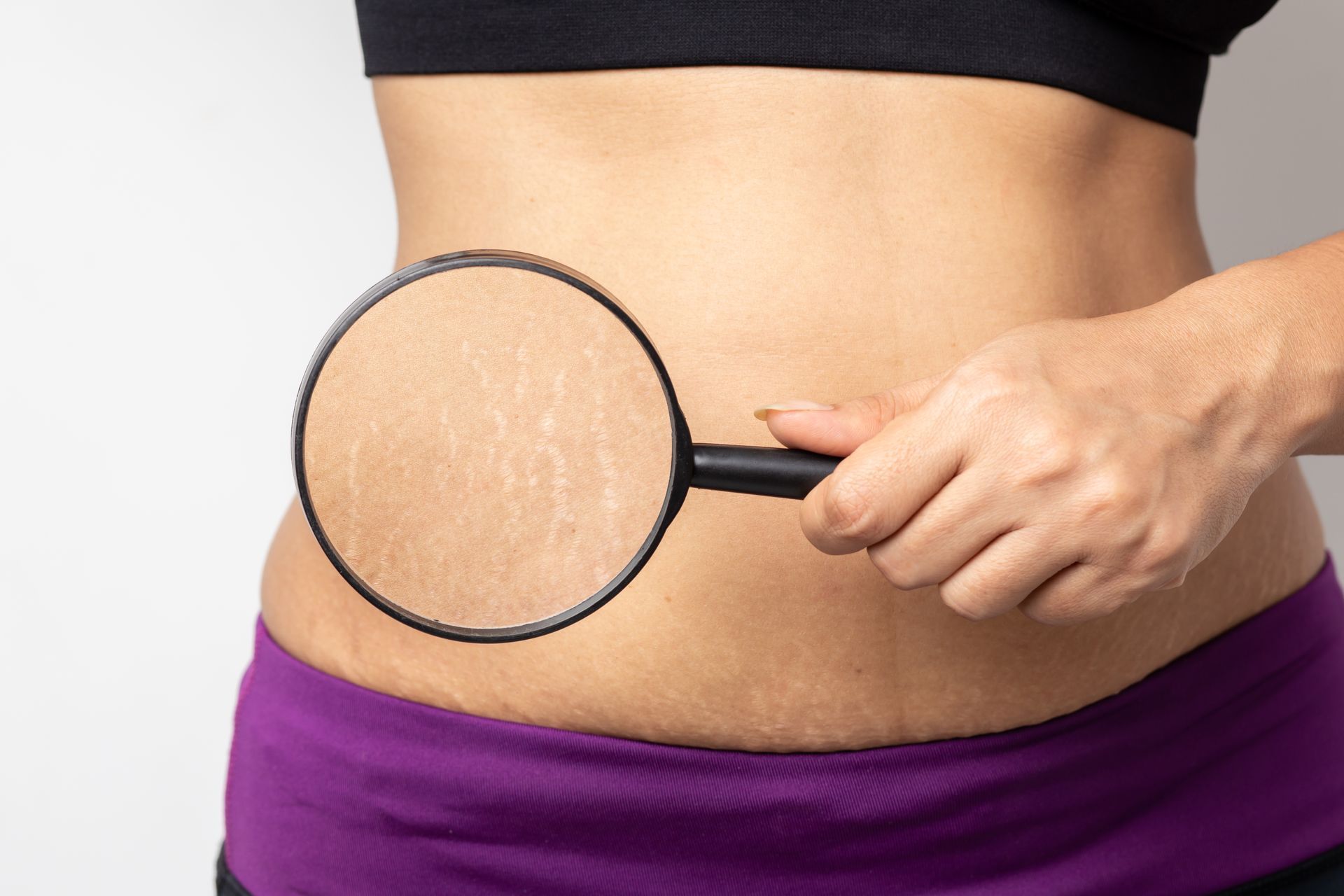 Woman's stomach with stretch marks, magnified by a handheld magnifying glass.