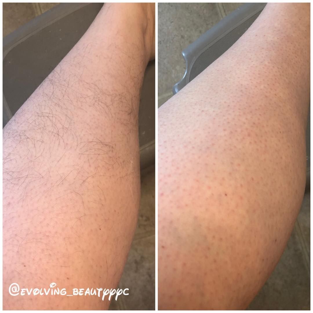 A before and after picture of a person 's leg.