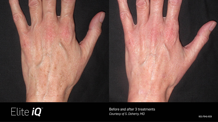 A before and after photo of a person 's hands