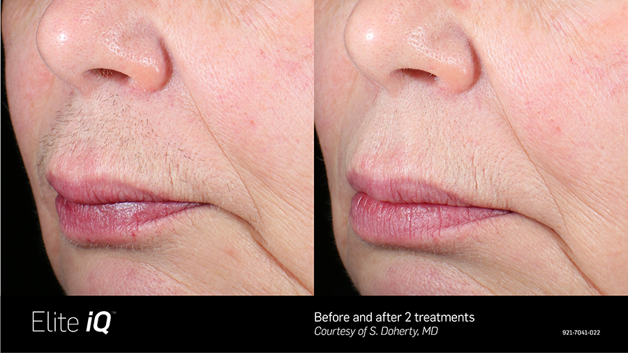 A before and after photo of a woman 's face.