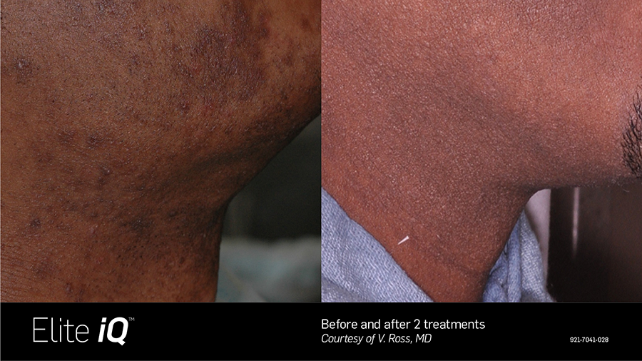 A before and after picture of a man 's neck