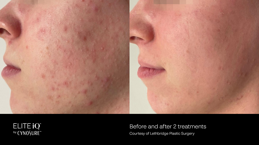 A before and after photo of a woman 's face with acne.