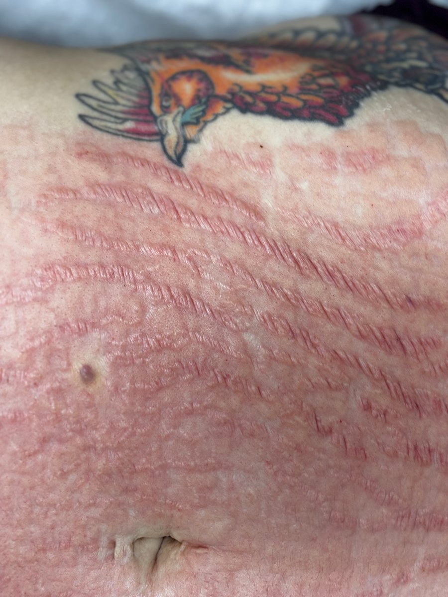 A close up of a person 's skin with a tattoo on it.