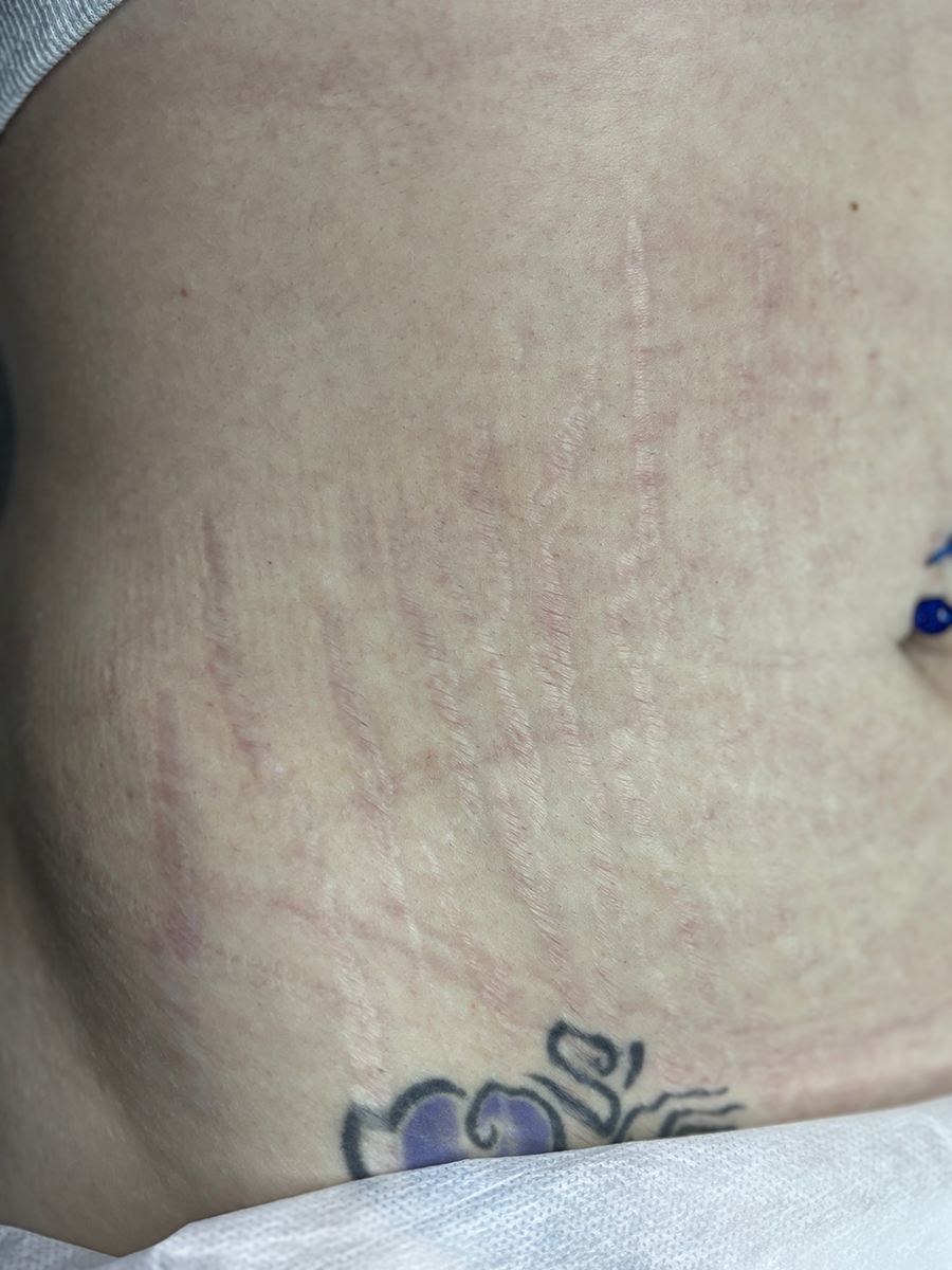 A close up of a woman 's stomach with stretch marks and a tattoo.