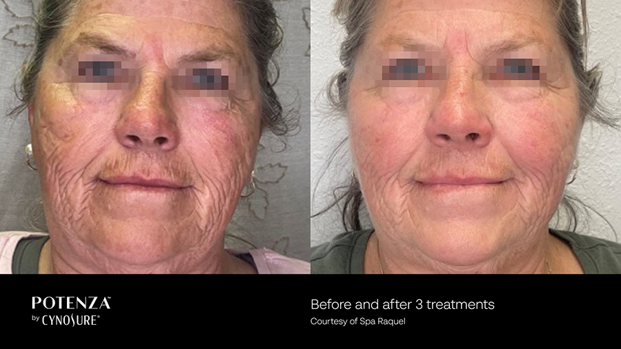 A before and after photo of a woman 's face.