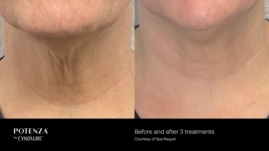 A woman 's neck is shown before and after a treatment.