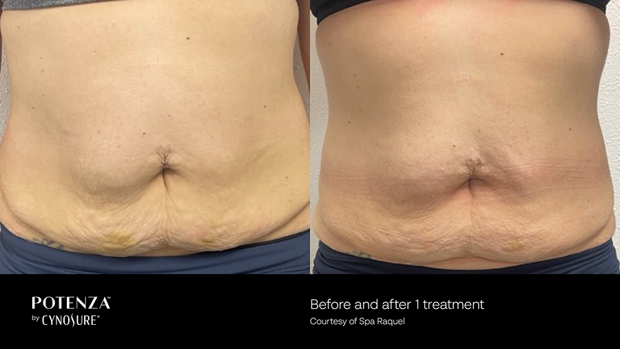 A woman 's stomach is shown before and after a treatment.