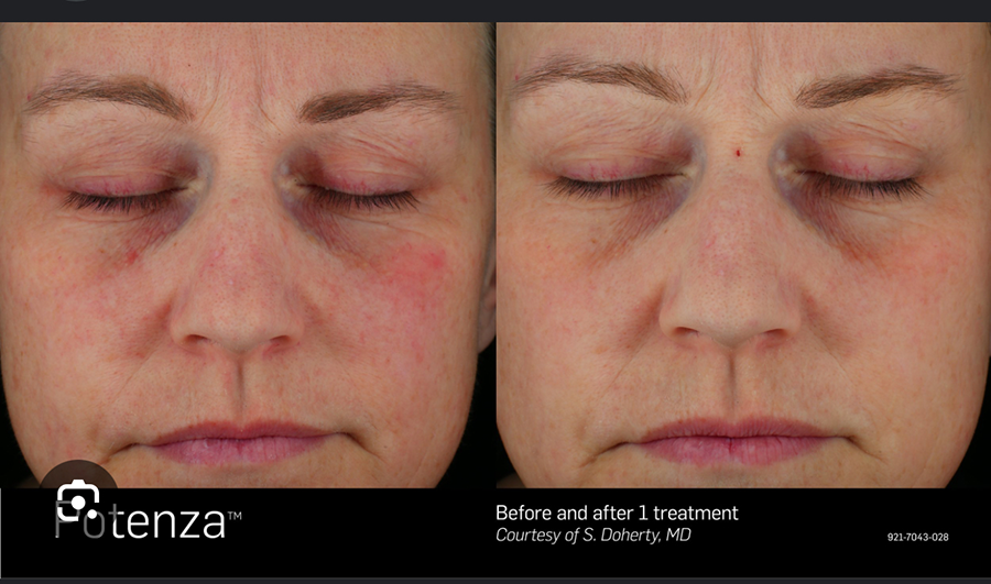 A before and after photo of a woman 's face