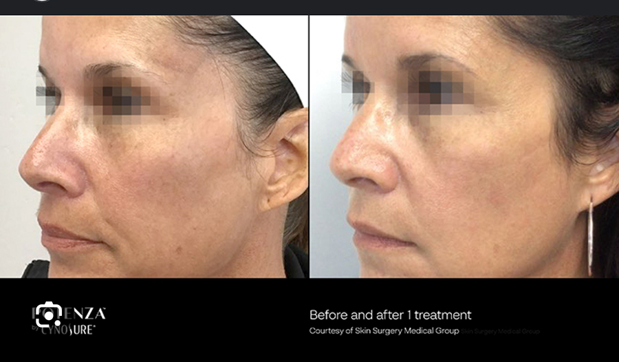 A woman 's face is shown before and after a treatment.
