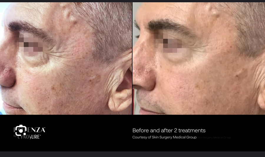 A before and after photo of a man 's face.