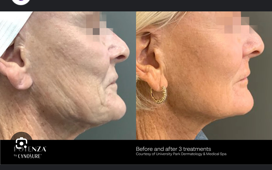 A woman 's face is shown before and after a treatment.