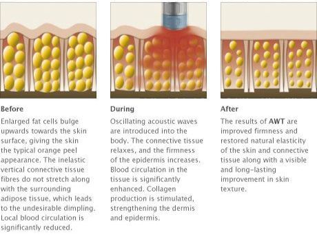 Cellulite Diagram
