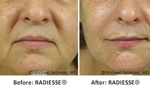 Before and After Radiesse