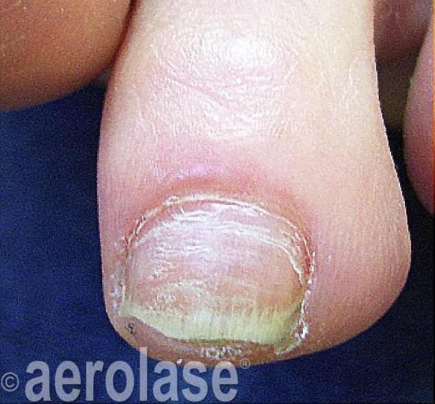 Nail Fungus after treatment 1