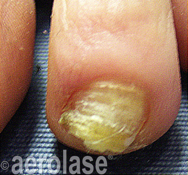 Nail Fungus before treatment 1