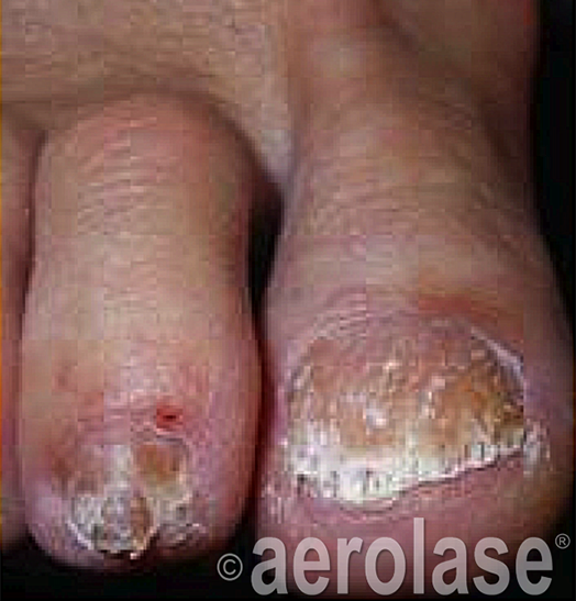 Nail Fungus before treatment 2