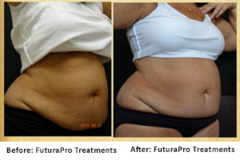 before and after futurapro treatment