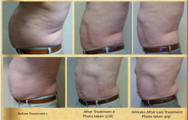 before and after Body Shaping 1