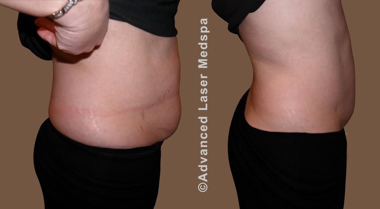 before and after Body Shaping 2