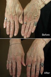 before and after treatment of hand