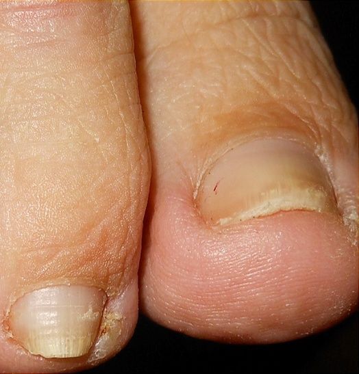 Nail Fungus after treatment 2