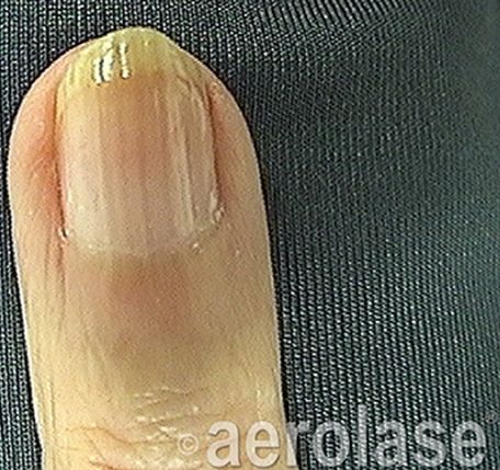 Nail Fungus after treatment 3