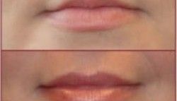 juvederm lips