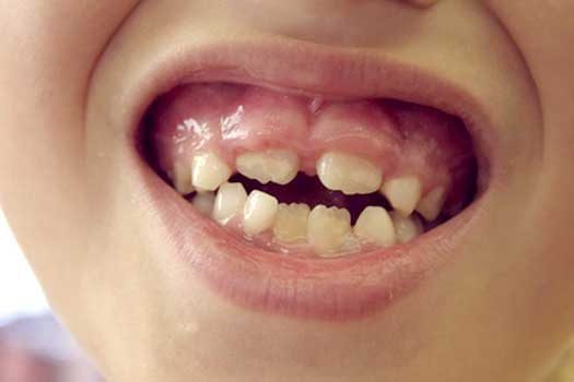 DRA. MARISELA MONARREZ SALDÍVAR - sangrado de encías