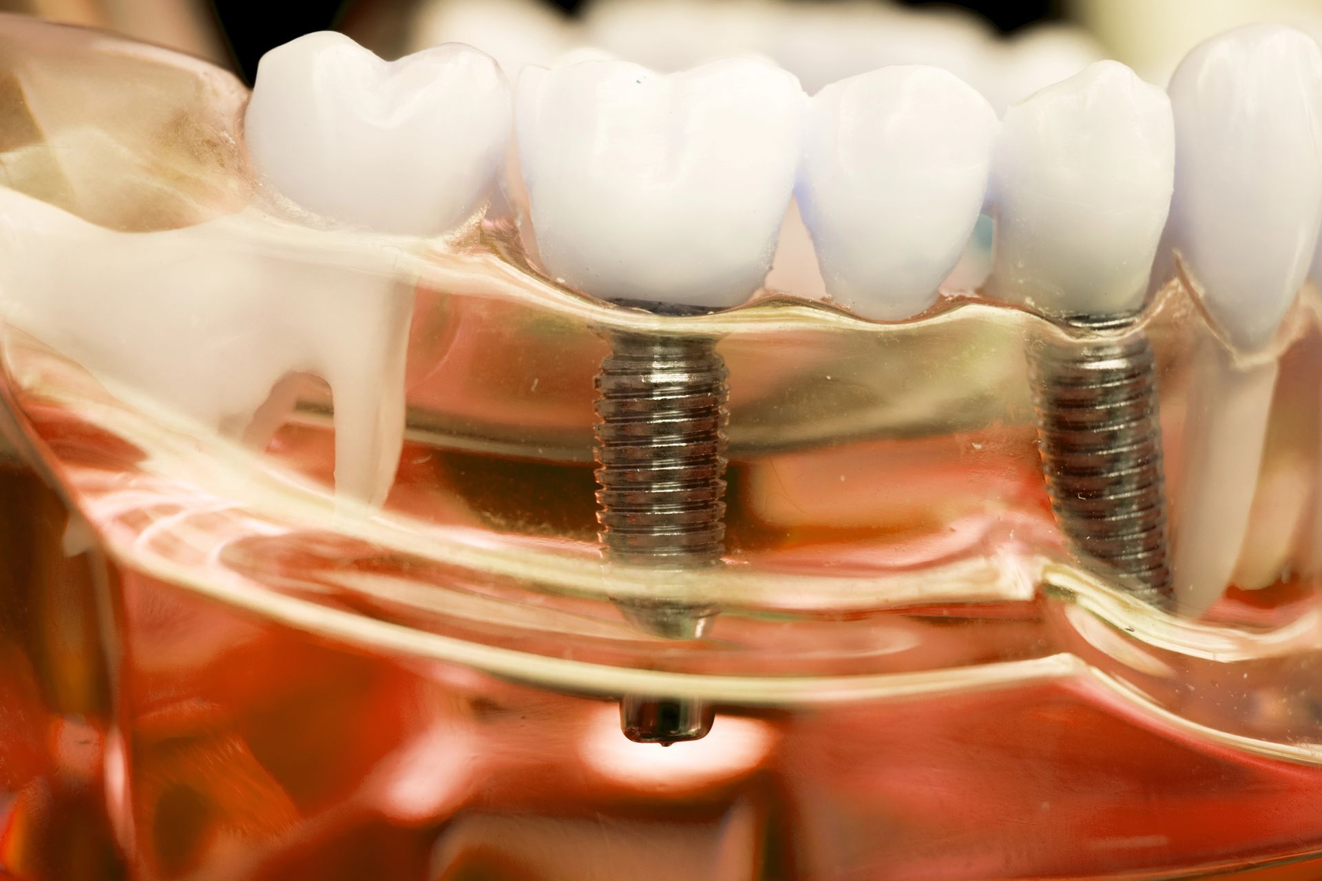 Primo piano di impianti dentali e di un modello di gengiva in acrilico con denti bianchi e perni metallici.