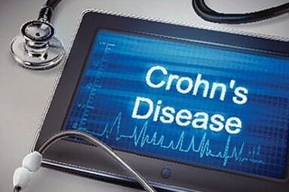 Crohn's Disease - upper GL endoscopy in Troy, NY