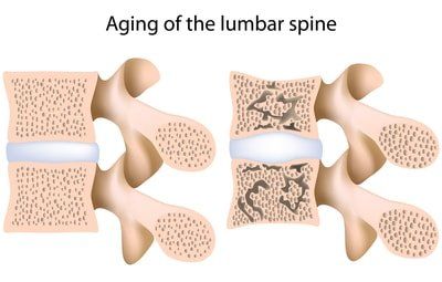 The spine ages and starts weakening, leading to pain and spinal issues that can be treated. 