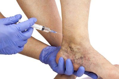 Injection treatments can help with troublesome veins. 