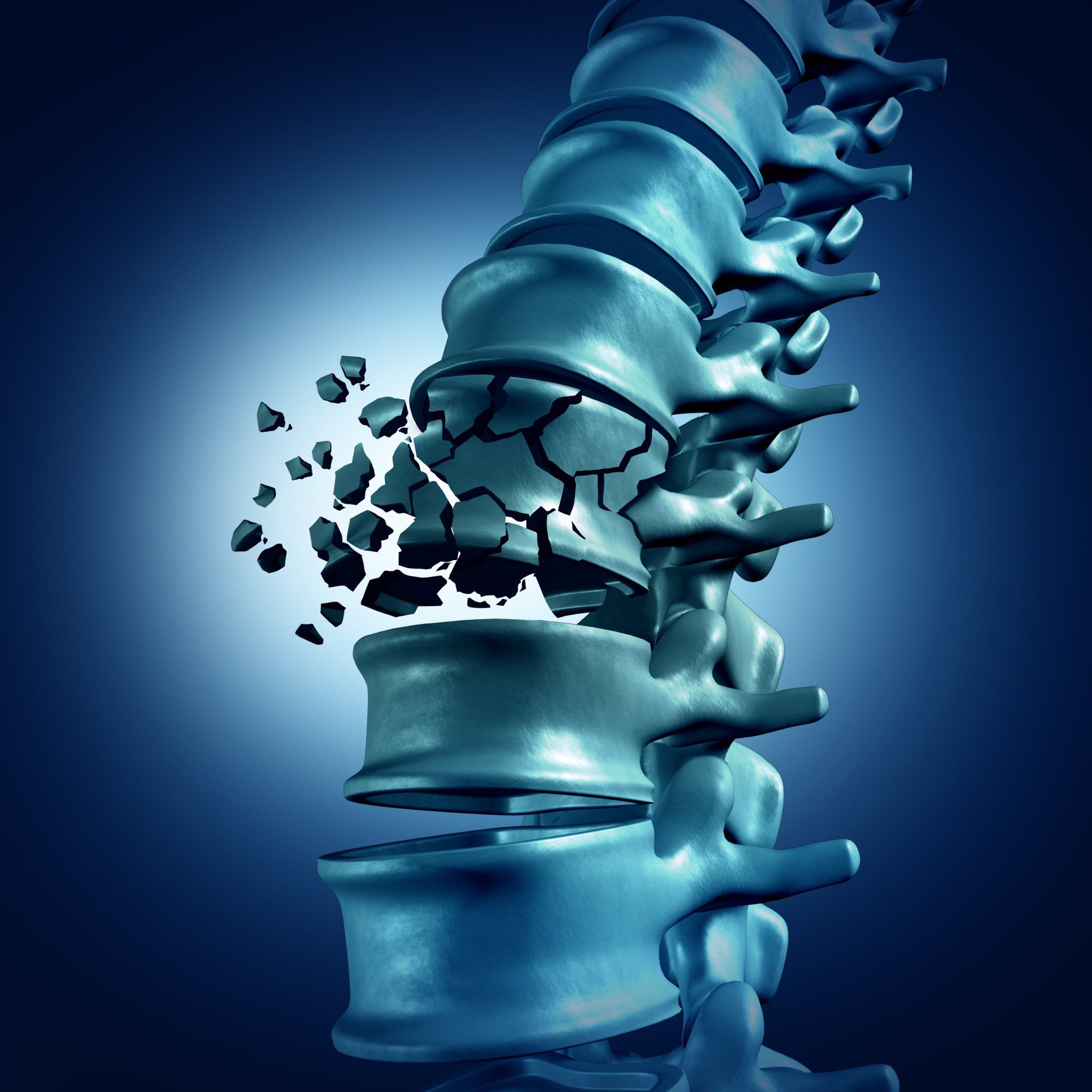 spinal fractures MACON VIRA