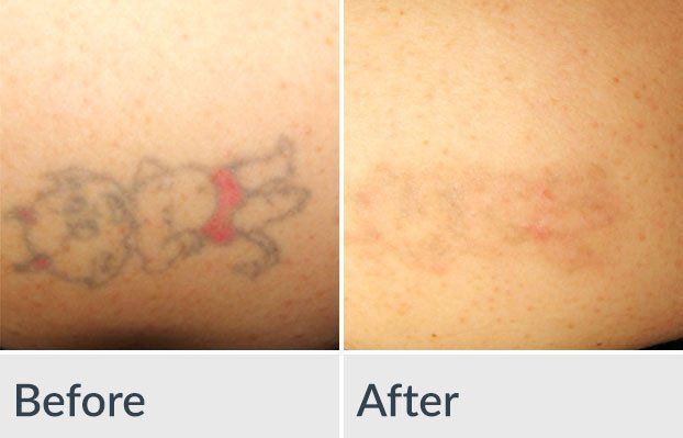 Eraser Clinic Alternatives (Tattoo Removal Clinic in Austin TX) -  Alternatives