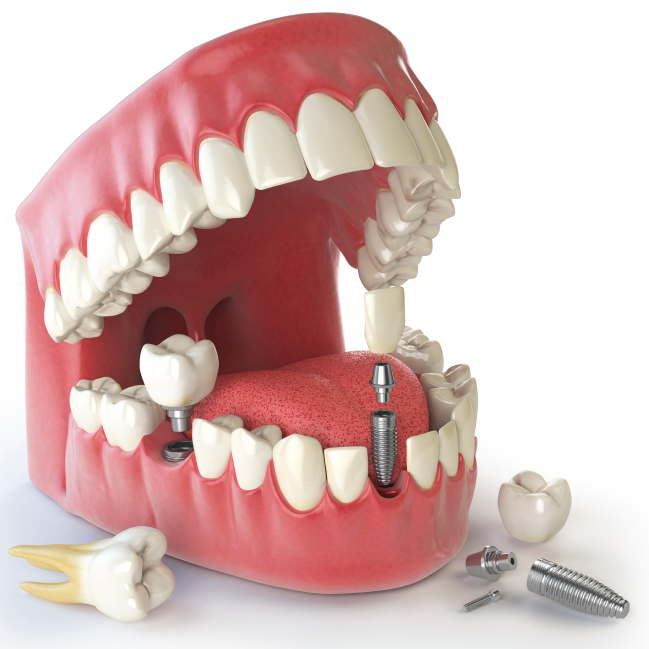 Dental Implants in Zephyrhills FL