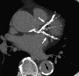 O que é o Escore de Cálcio Coronariano e Como Ele Pode Beneficiar Sua Saúde Cardiovascular
