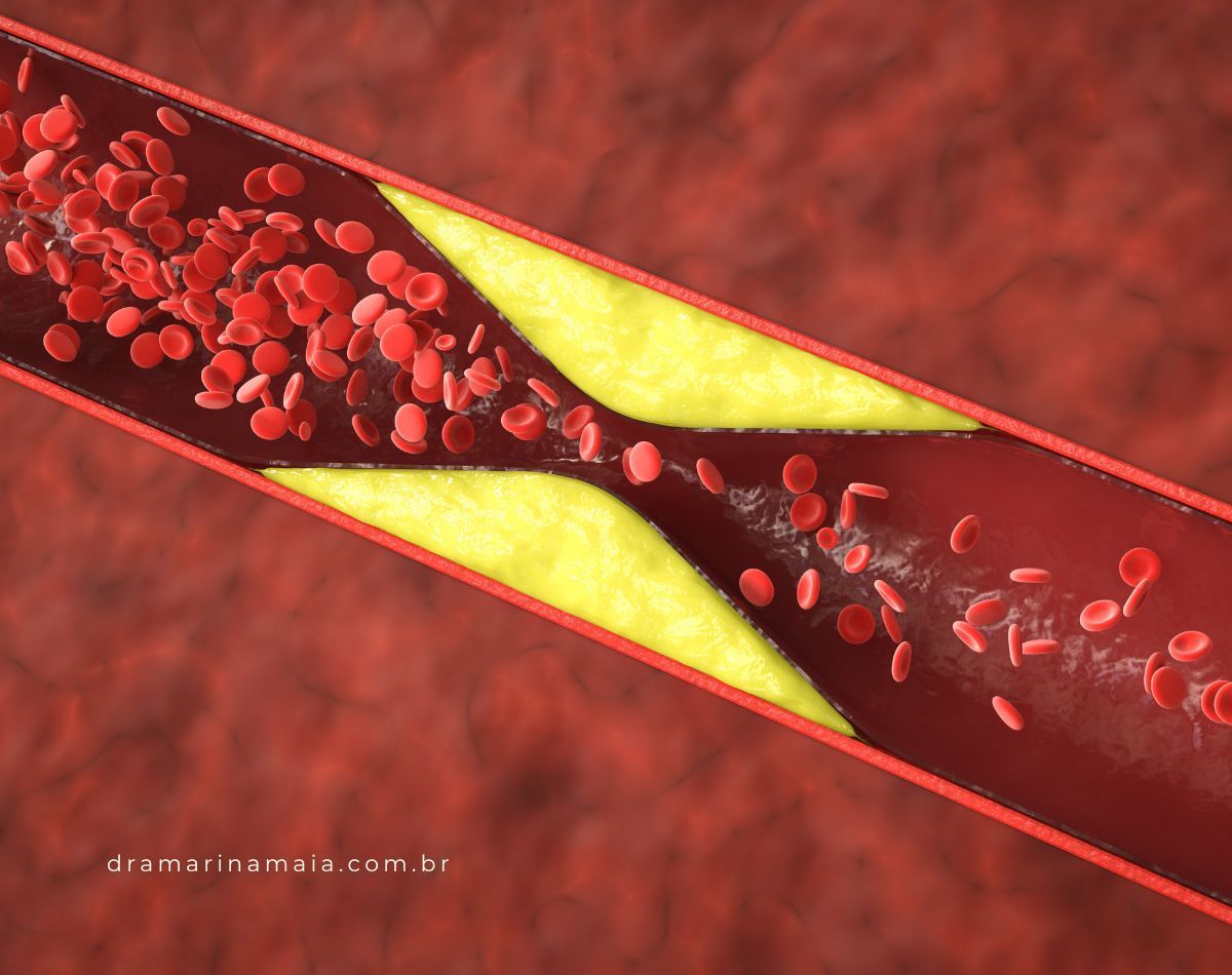 Sintomas do Colesterol Alto - O que Você Precisa Saber