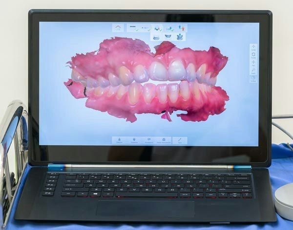 image on laptop of teeth